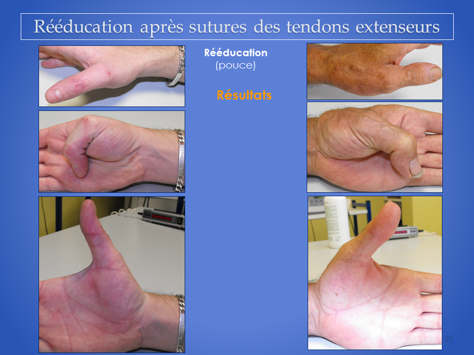 Rééducation après lésion des tendons extenseurs des doigts - Denis