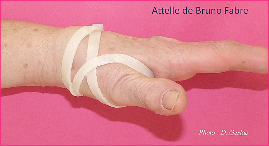 kine-specialiste-main-grenoble-attelle-rhizarthrose