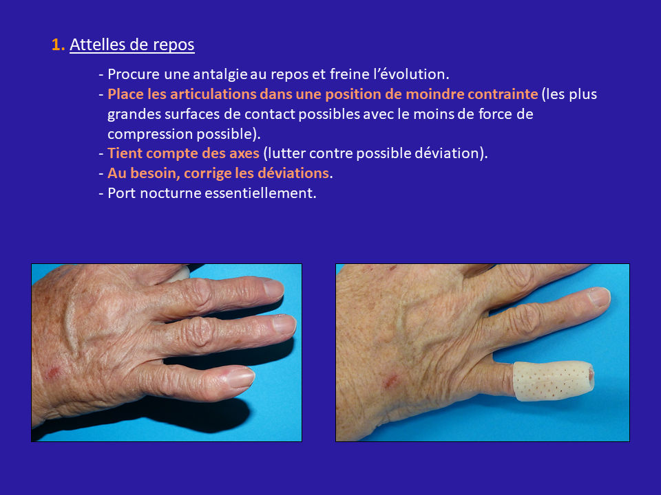 Arthrose digitale - Denis GERLAC - Rééducation et Orthèse de la Main et ...