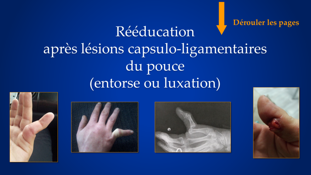 entorsepouceentorsepouceentorsepouce Denis GERLAC Rééducation et Orthèses de la Main