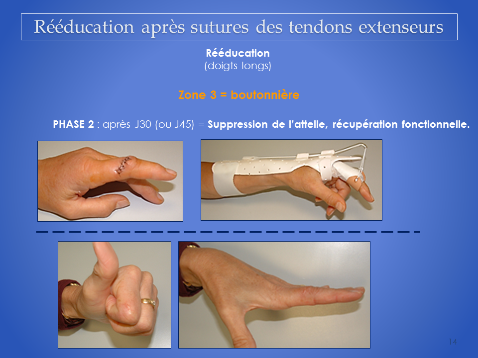 Mauepersu – Lot De 2 Extenseurs De Doigts Réglables En Silicone – 8 Niveaux – Pour Musique, Sport, Rééducation