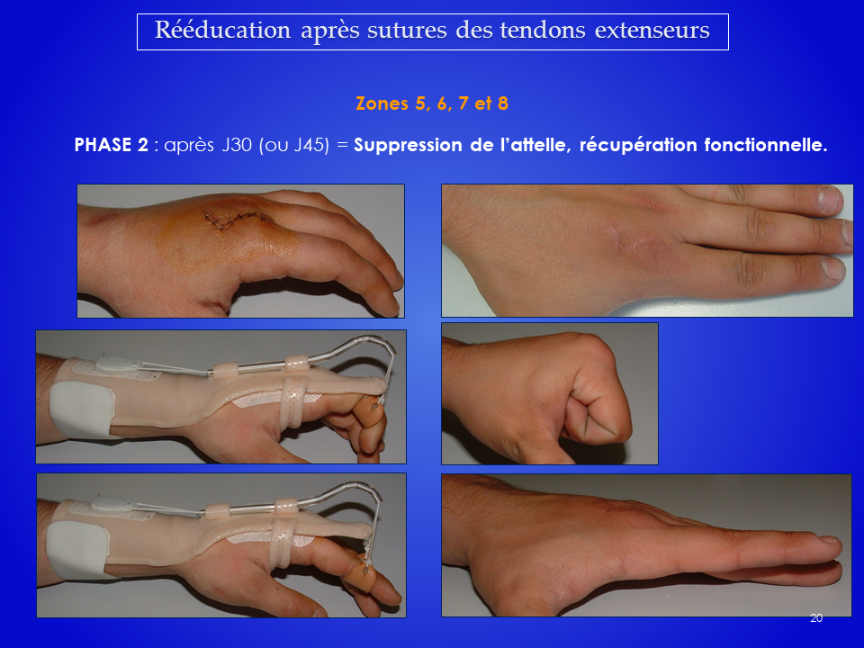 Auto-rééducation de la main et du poignet à la suite d'une opération